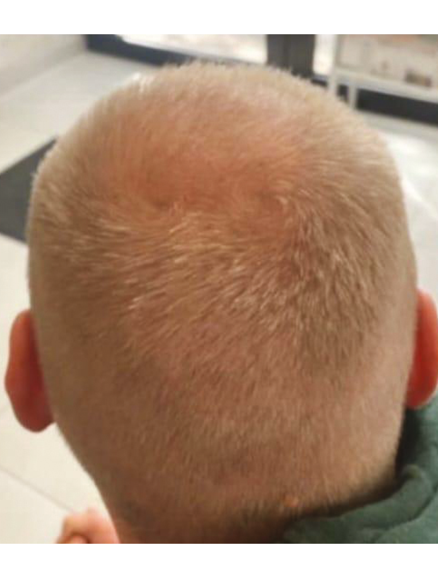 After 16 weeks - dramatic hair density improvement on crown