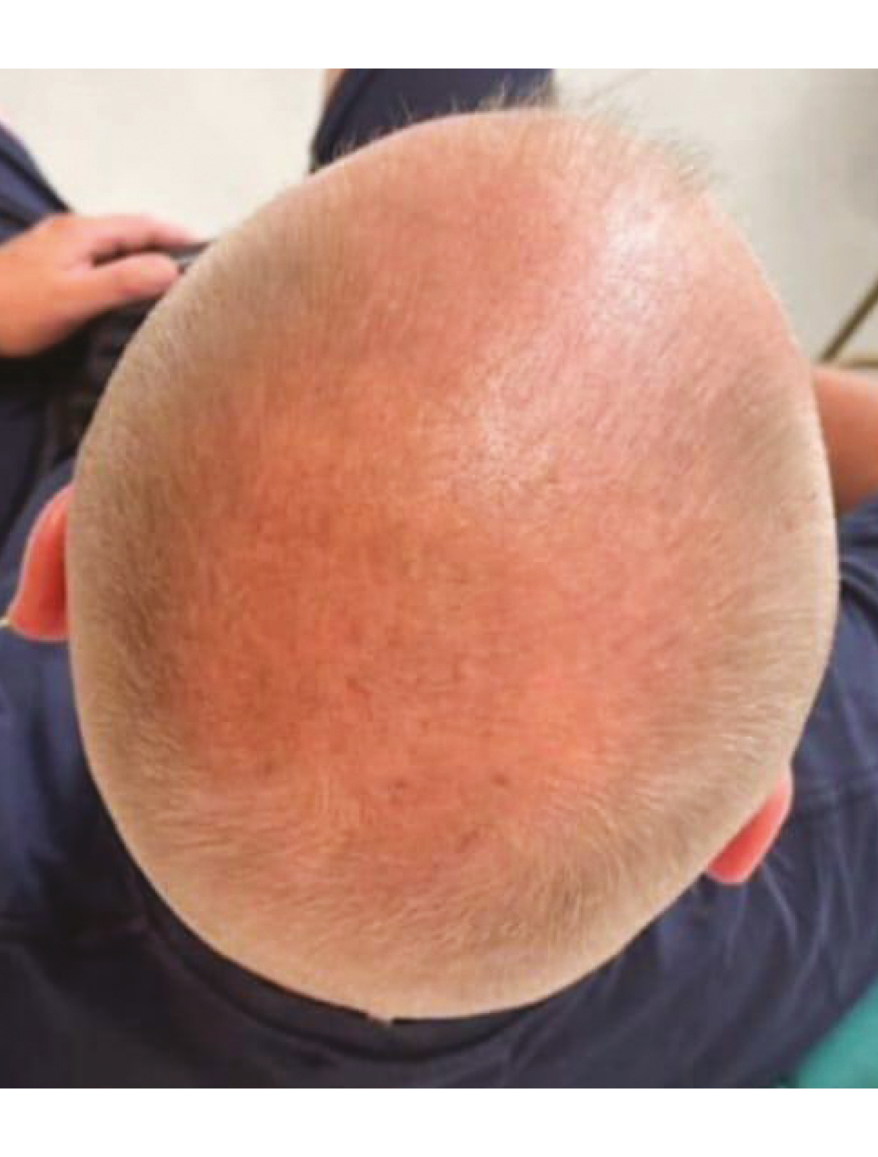 Before treatment - significant hair thinning on crown